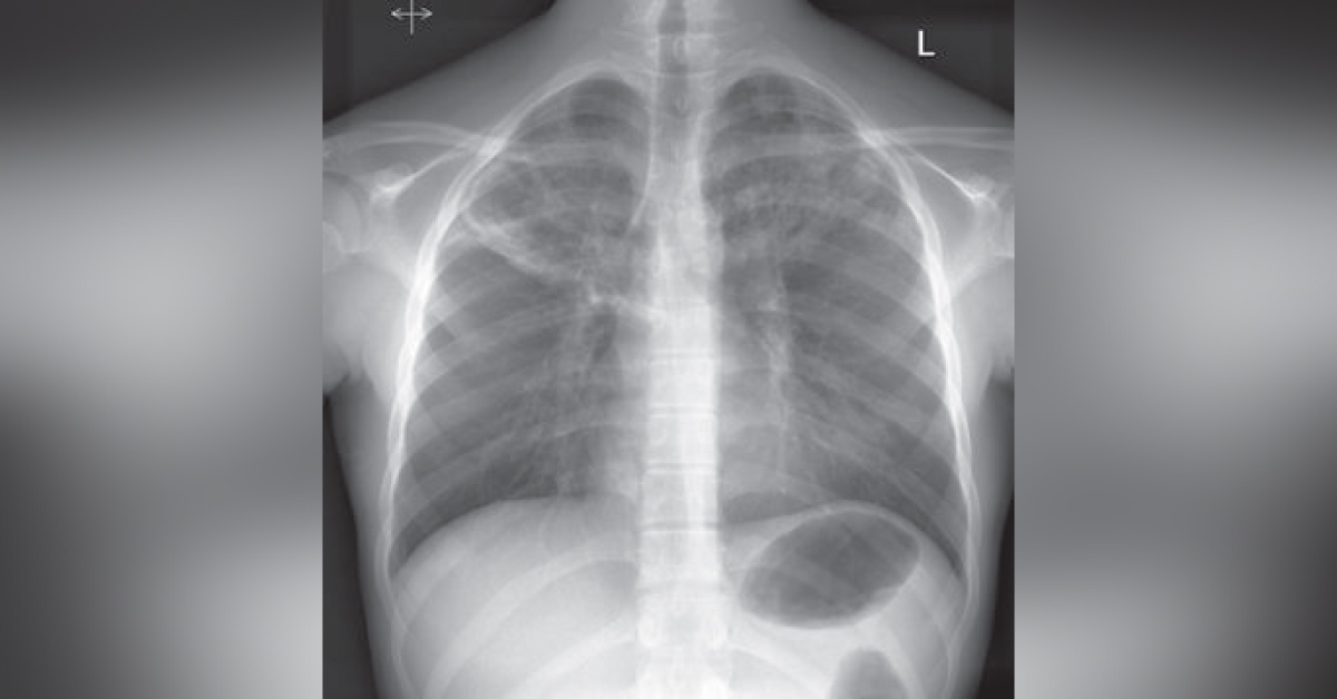 Hemoptysis In A Tourist After An International Trip
