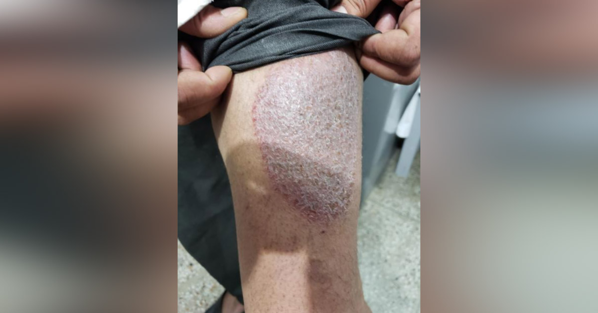 Tinea With Eczematization In Central Area Or Some Other Disease?