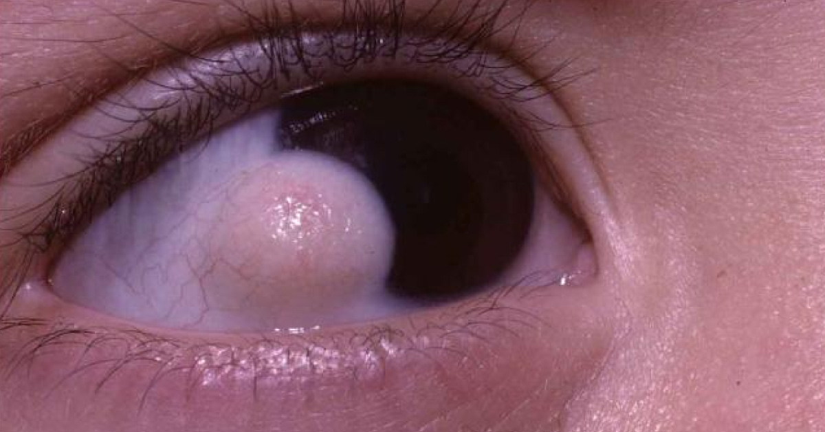 Scenario Of Limbal Dermoid