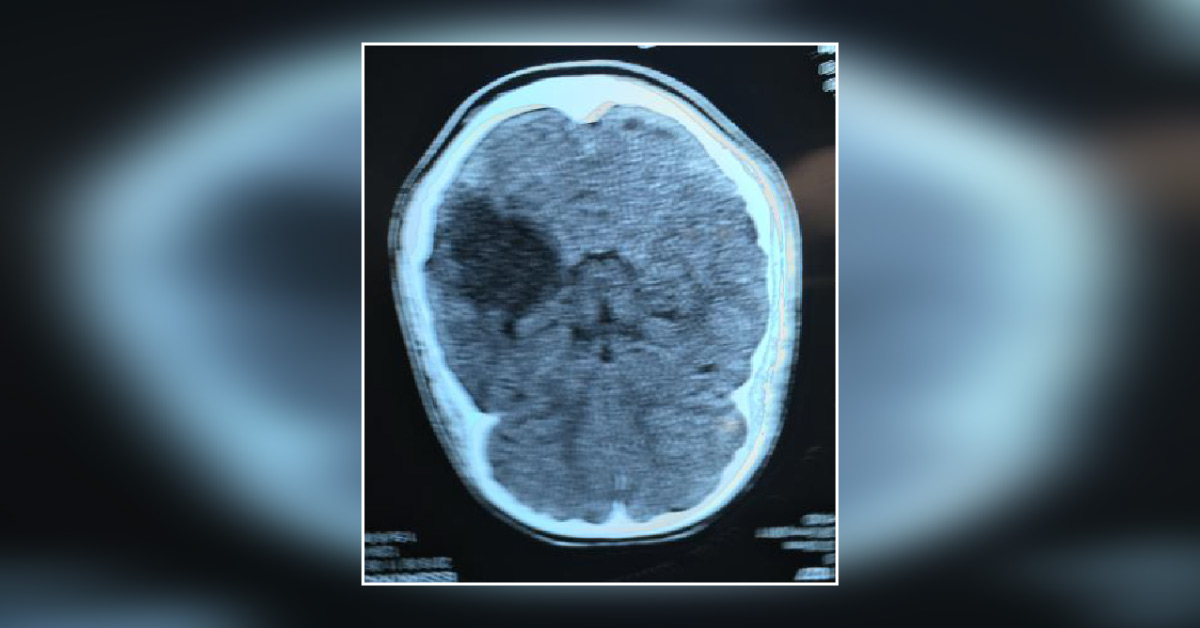 Focal Cortical Dysplasia