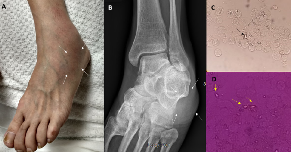 Pseudogout: A Rare Cause of Joint Swelling
