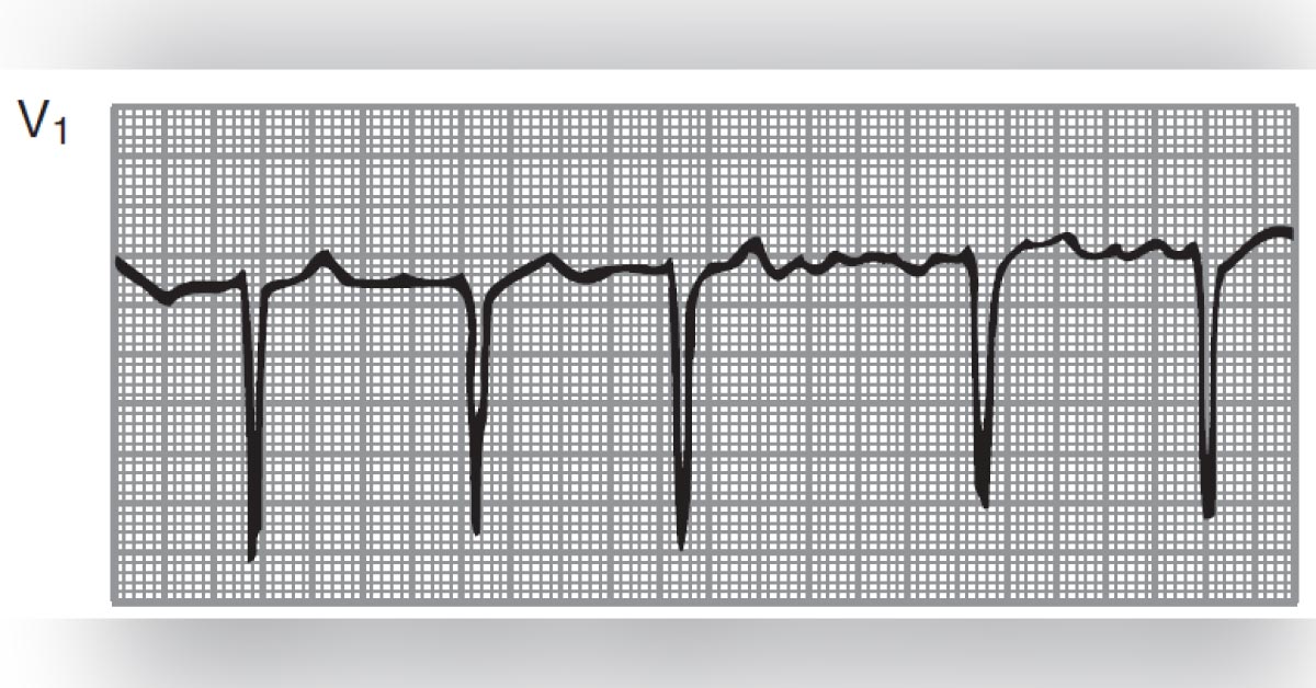 A Pregnant Woman with Sudden Onset of Palpitations