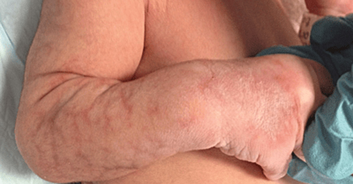Case of a Newborn with Blue Violet Skin Lesions on His Right Forearm and Leg