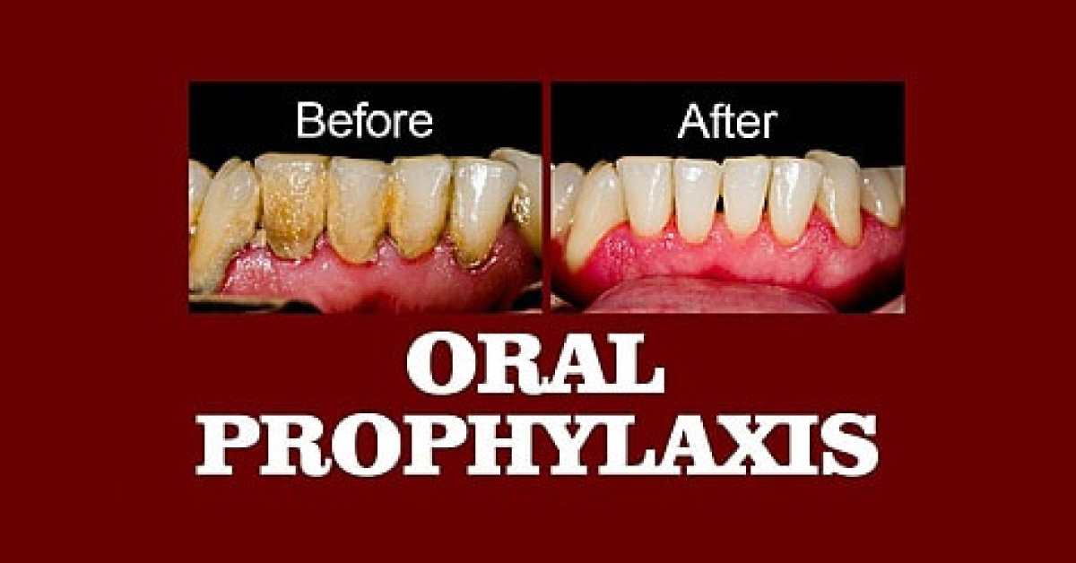 All You Need To Know About Oral Prophylaxis