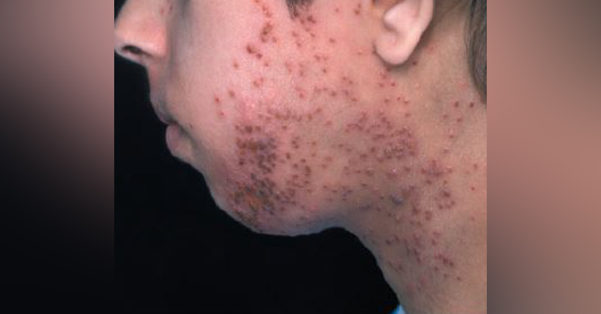 A Case Of Acute Monomorphic Eruption