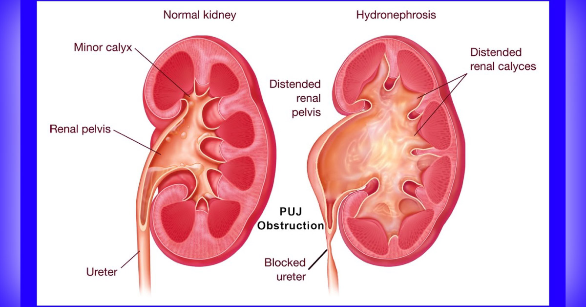 Guidelines To Manage Antenatally Detected Hydronephrosis Due To PUJ Obstruction