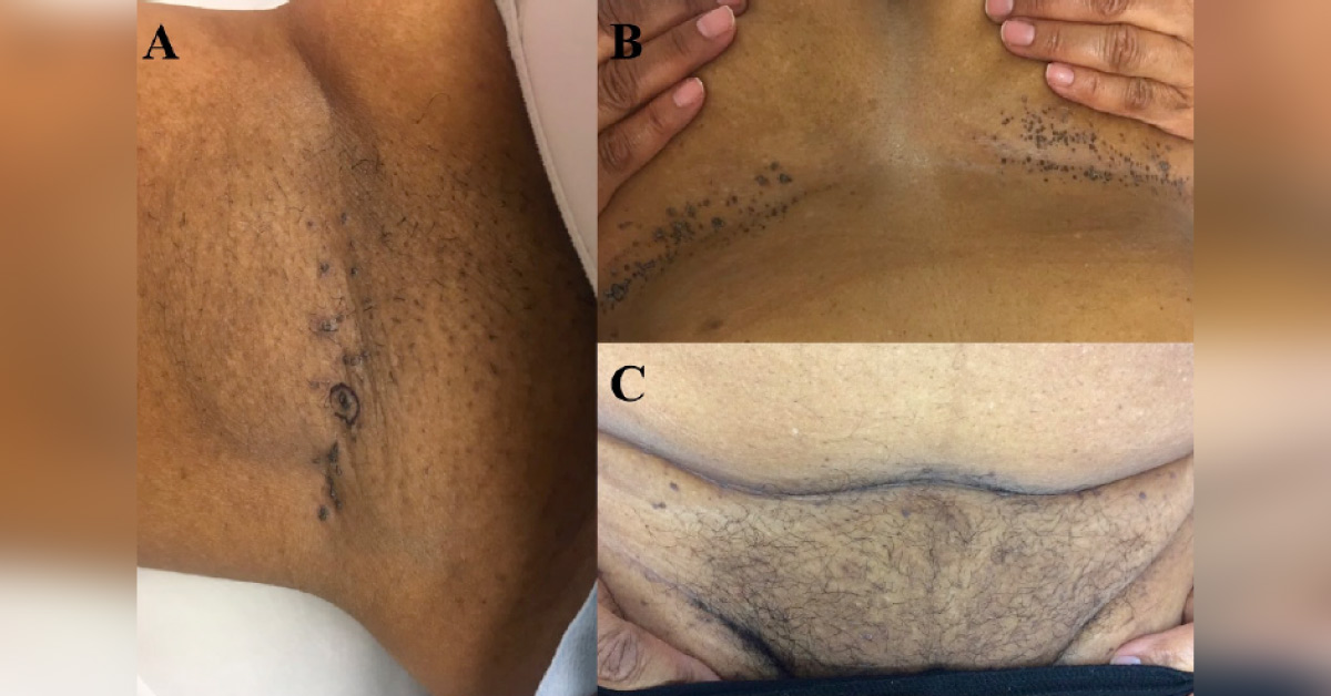 Case of a Woman with Pruritic Papules