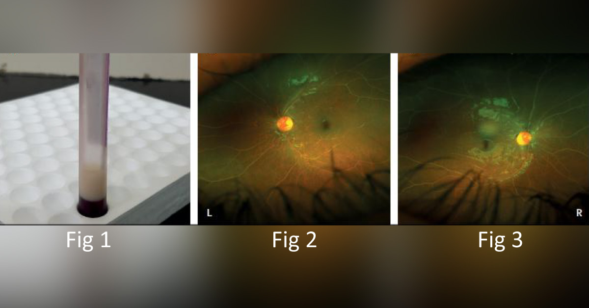 A Young Boy with a Milky White Appearance of Plasma and Retinal Blood Vessels