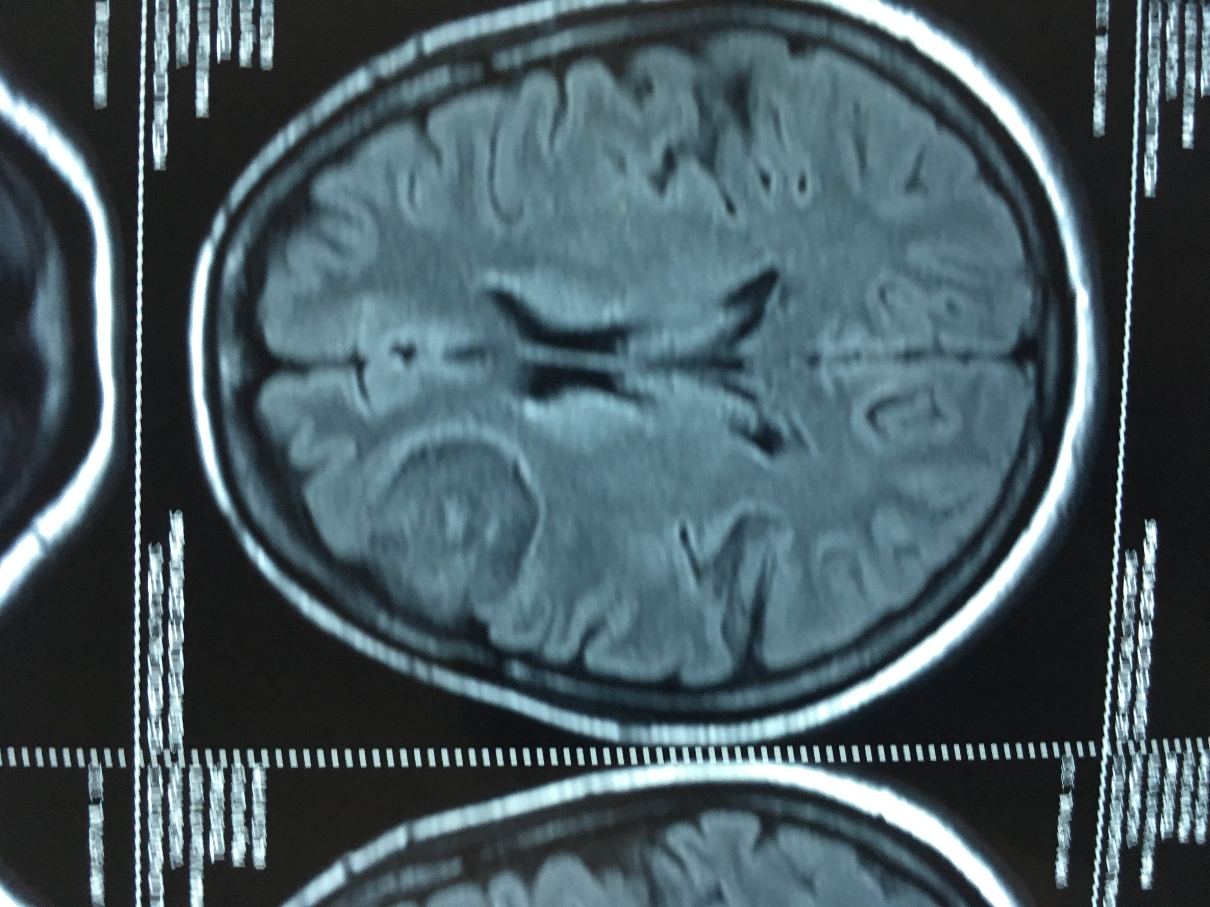 An Incidental Finding Of Neurosurgical Importance