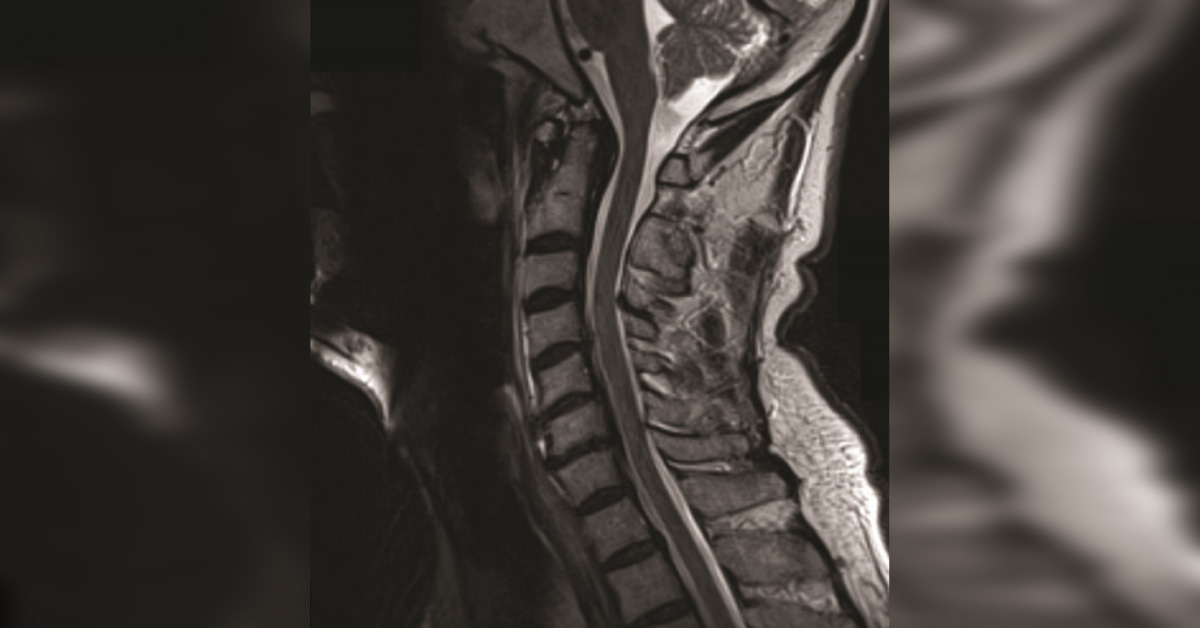A Rare Complication Of A Patient With Pseudogout