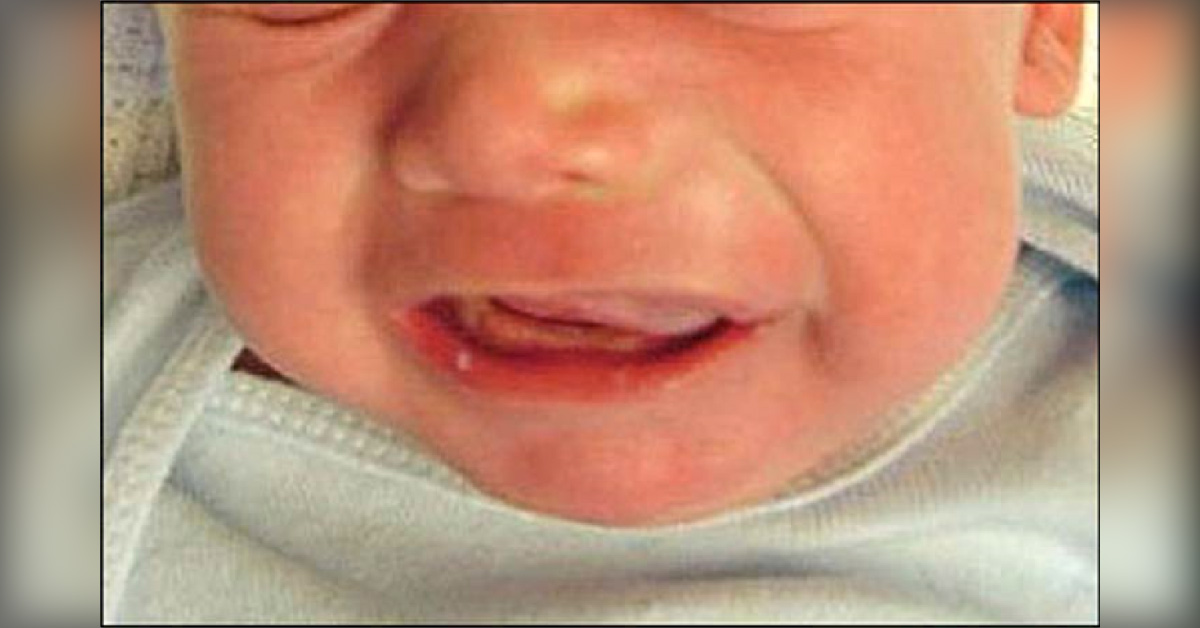 Left Anterior Maxilla Swelling in an Infant