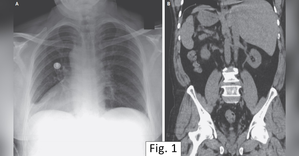 Case of an Immigrant with Severe Pain in His Chest and Abdomen