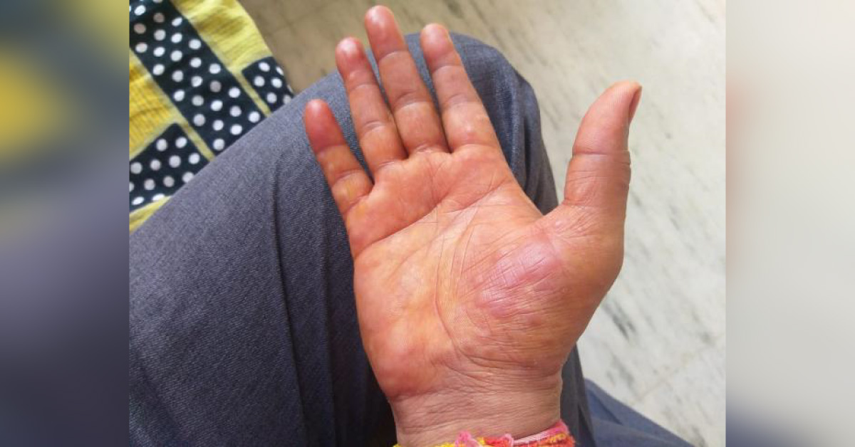 Blister An Redness