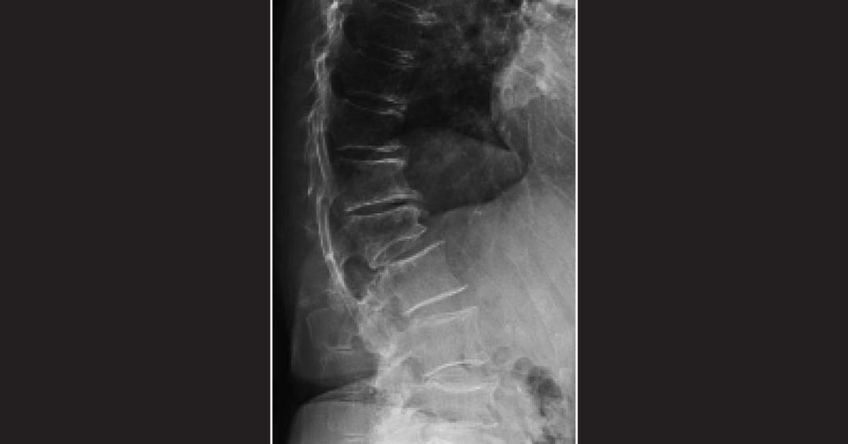An Elderly Woman with a Stooped Posture: What's Your Diagnosis?
