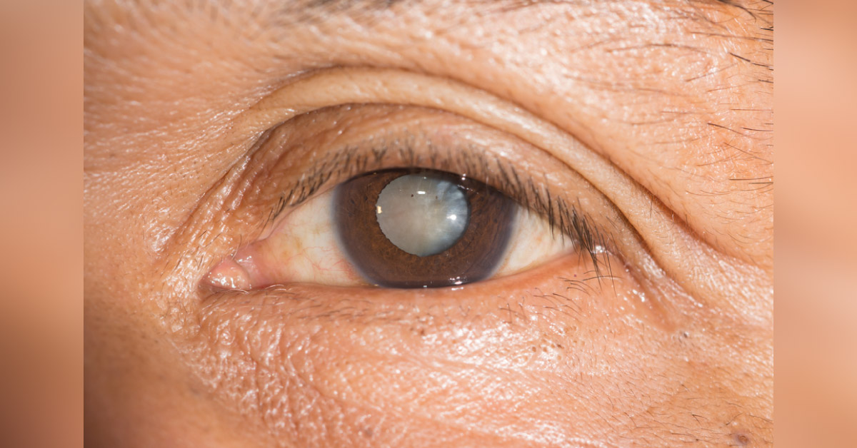 Rare Causes Of Cataract Psoriasis