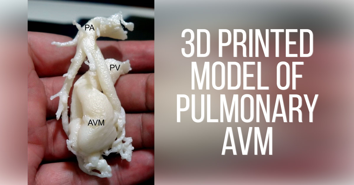 Role Of 3D Printing In Surgical Management Of Cardiovascular Diseases