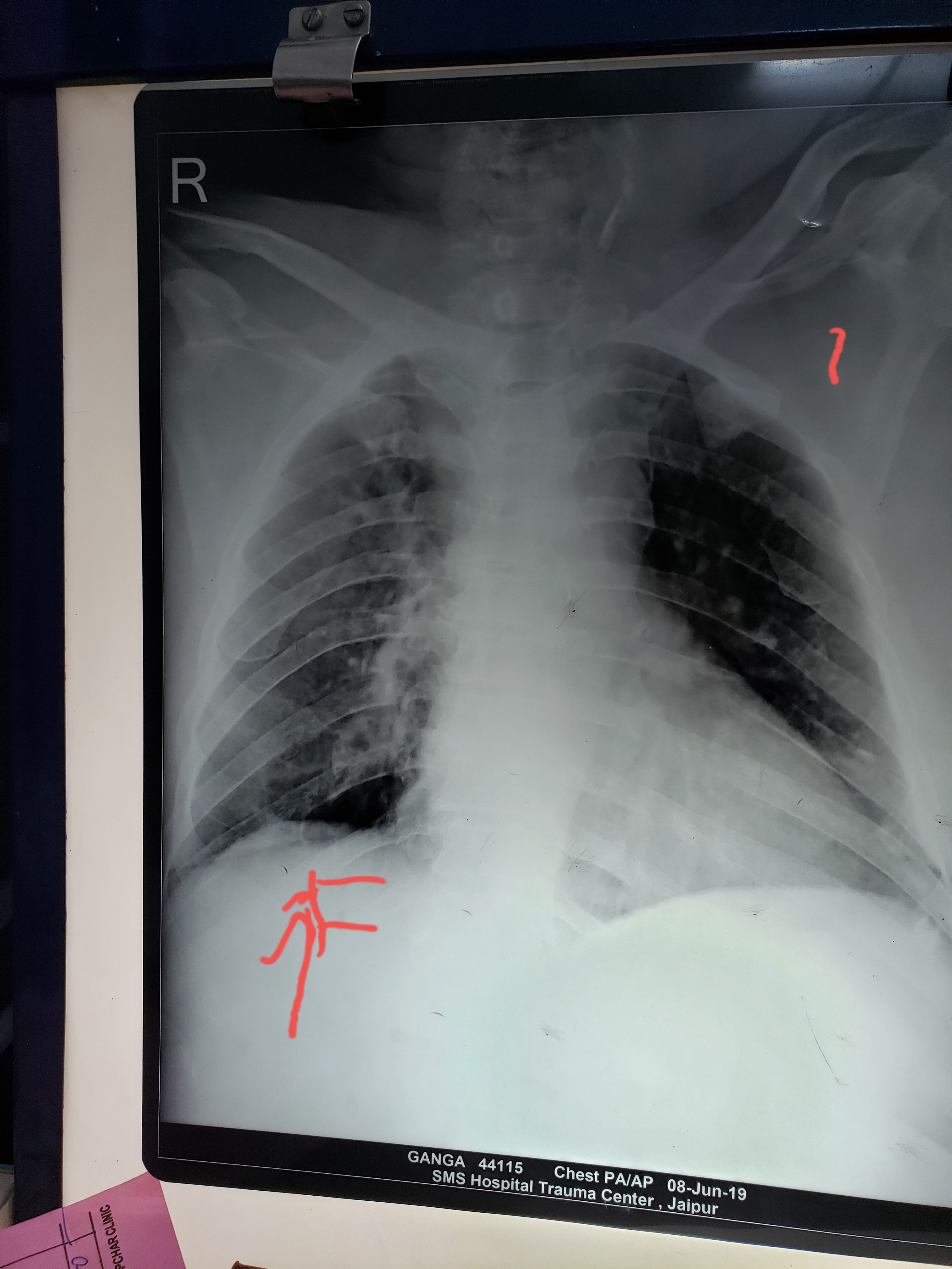 Is There Any Pathology In The Marked Areas ?