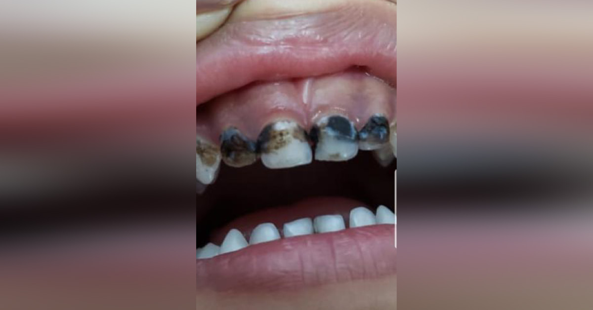 What Is This Stain / Disease On Teeth Of A Kid
