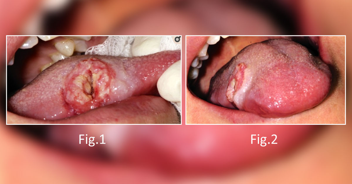 A 26-year-old with a Painful Tongue Lesion