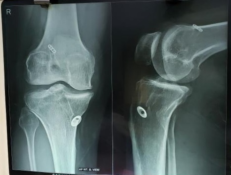 What Is The Cause Of Pain In Knee Rt, Ten Years Later?