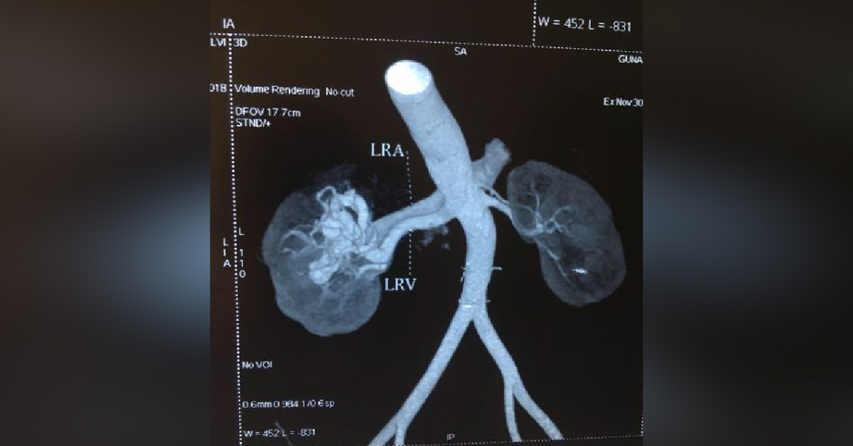 Secondary Hypertension - Rare Etiology