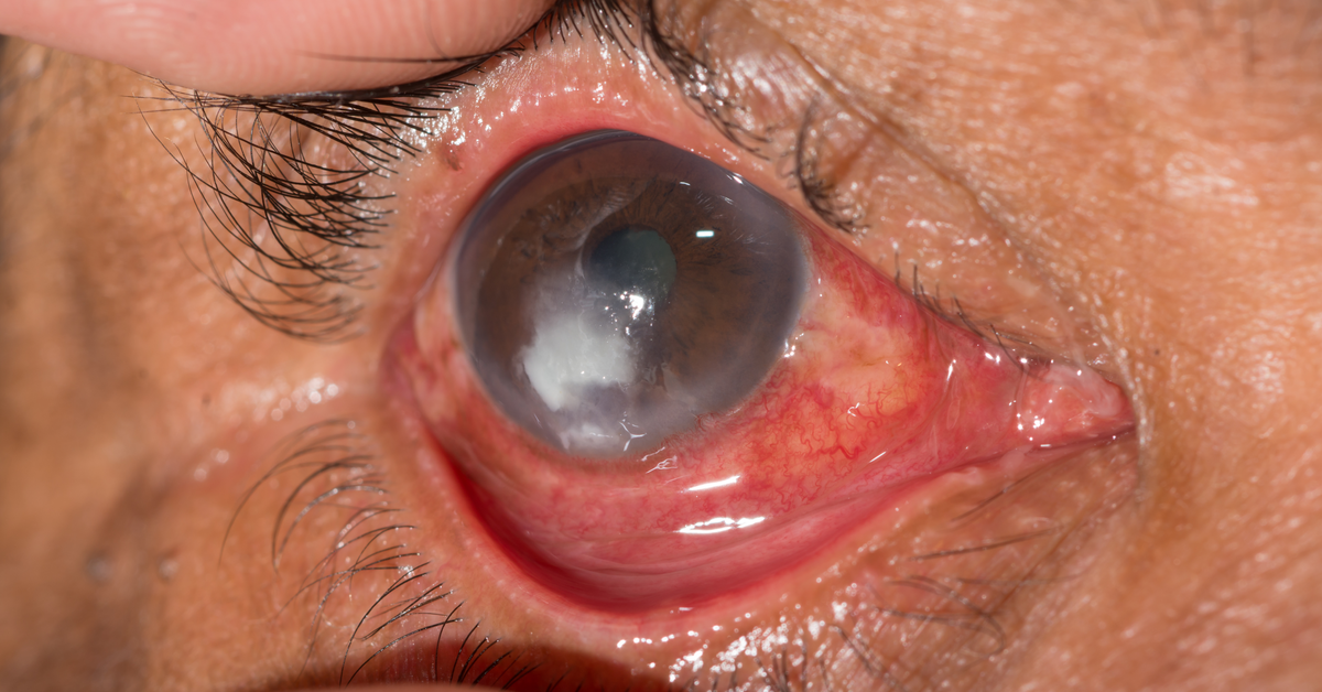 All You Need To Know About Mooren's Ulcer