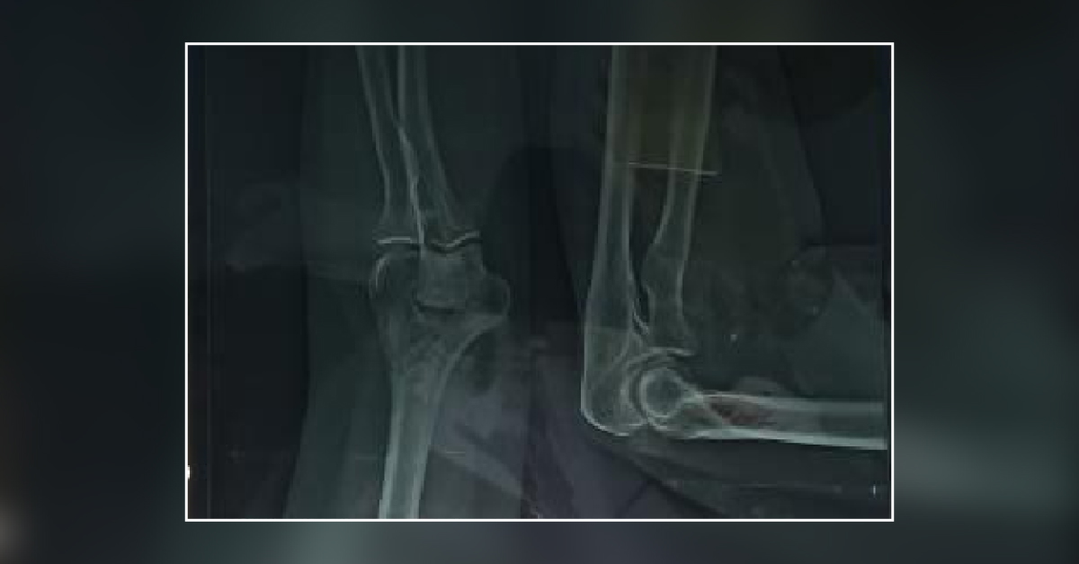 What Is Cause Of Pain In The Right Elbow?