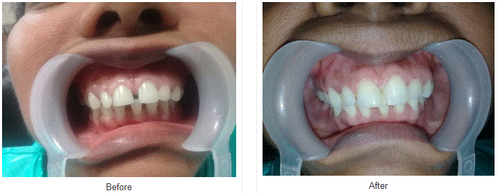 Magic Of Tooth-Colored Restorations Or Fillings