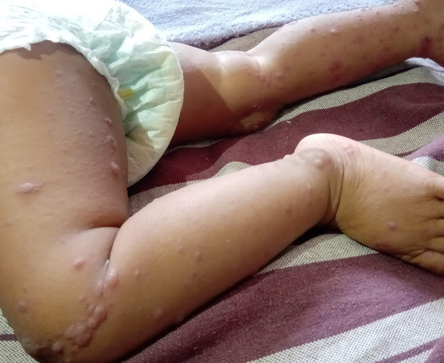 Hand Foot Mouth Disease, Changing Pattern