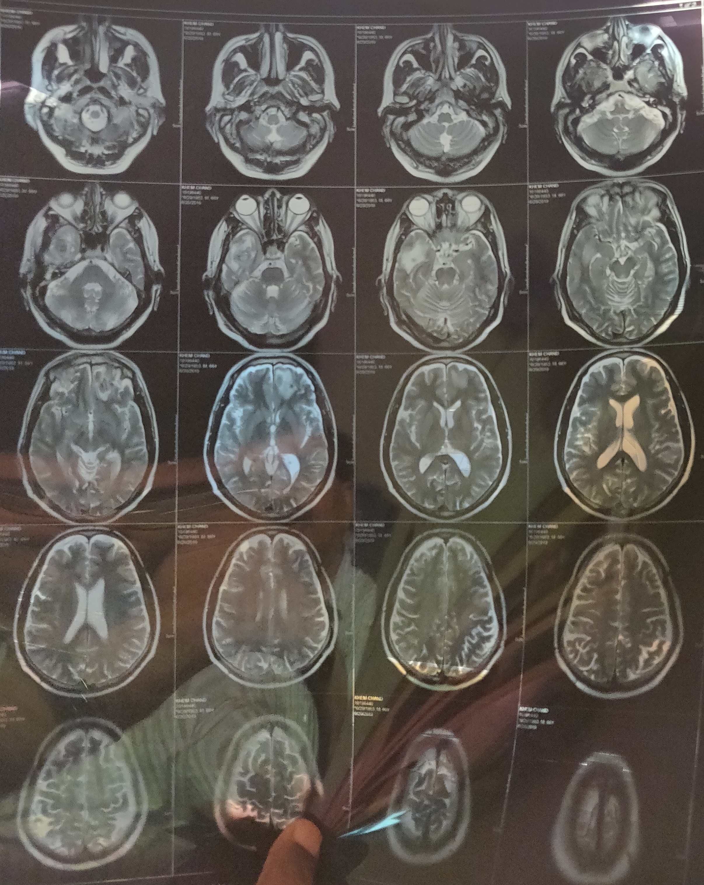 Just A Disease Or Epidemic Of Cerebral Venous Sinuses Thrombosis