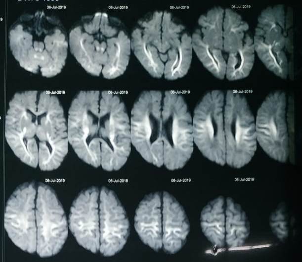Challenging Problem Of Developmental Delay