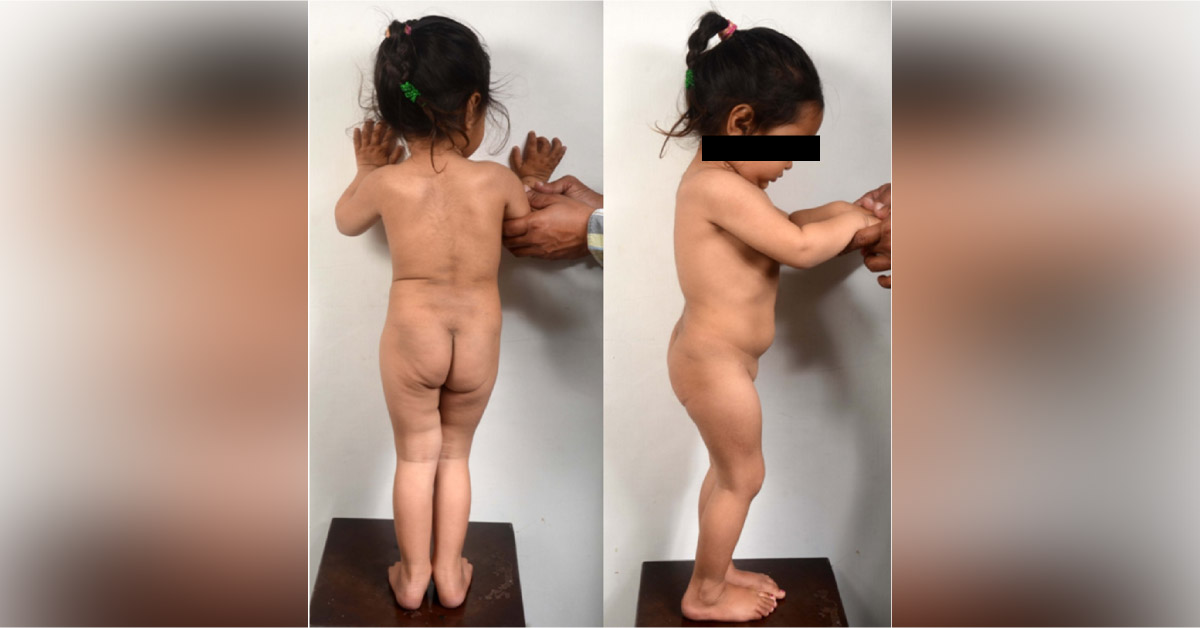Case of a Girl with Morquio A Syndrome