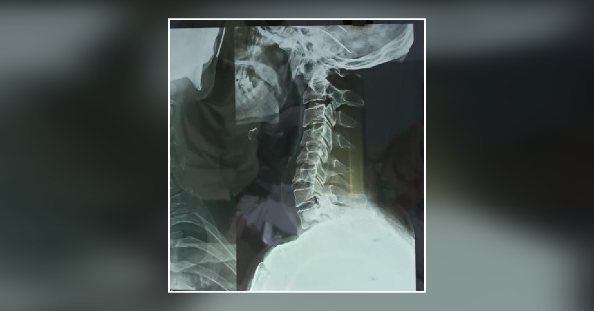 What Is Abnormal In This X Ray Cervical Spines?