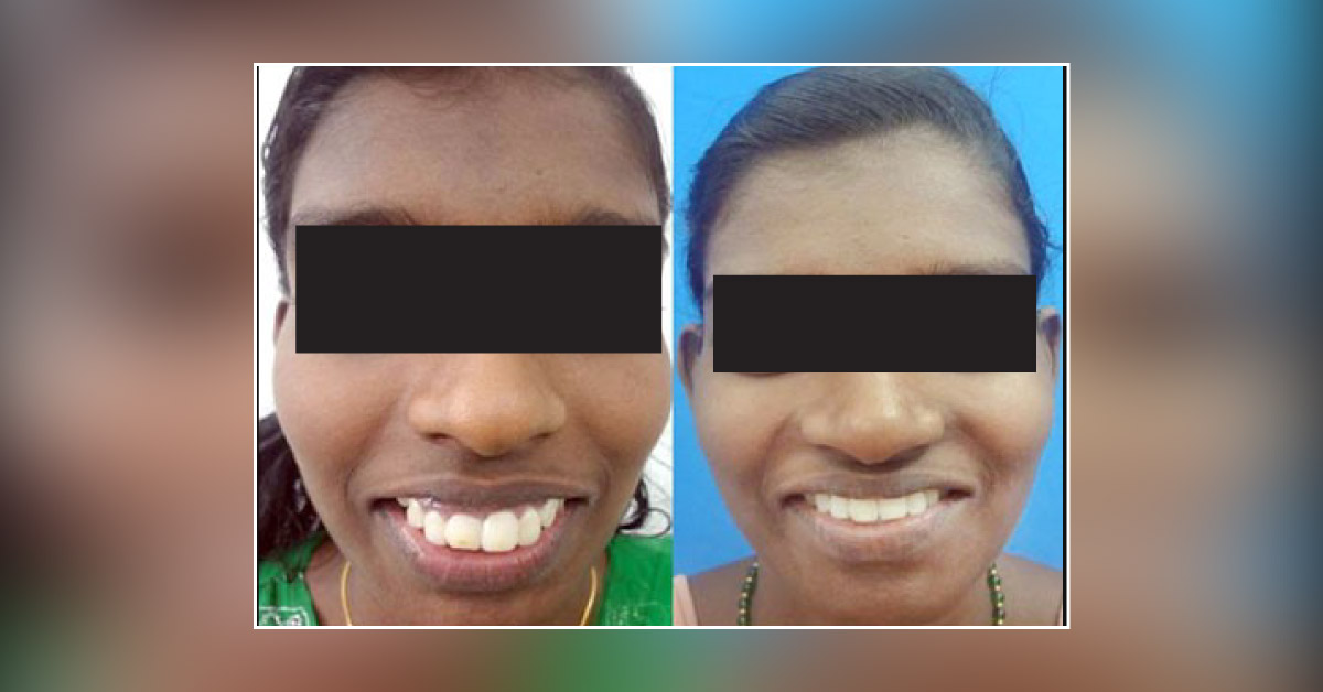 A Patient With Excessive Gummy Smile