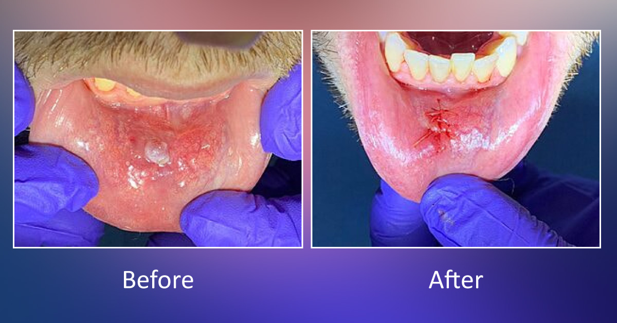 Intra Oral Biopsy – How It Could Be Life Saving