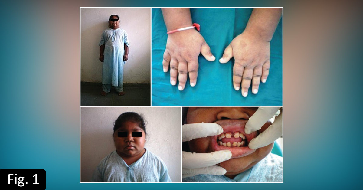 A Rare Dental Manifestation of Hypothyroidism