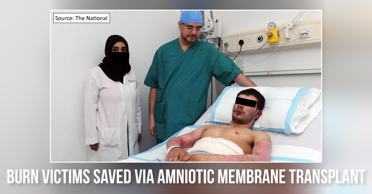 UAE’s First-Ever Amniotic Membrane Transplant For The Treatment Of Burn Wounds