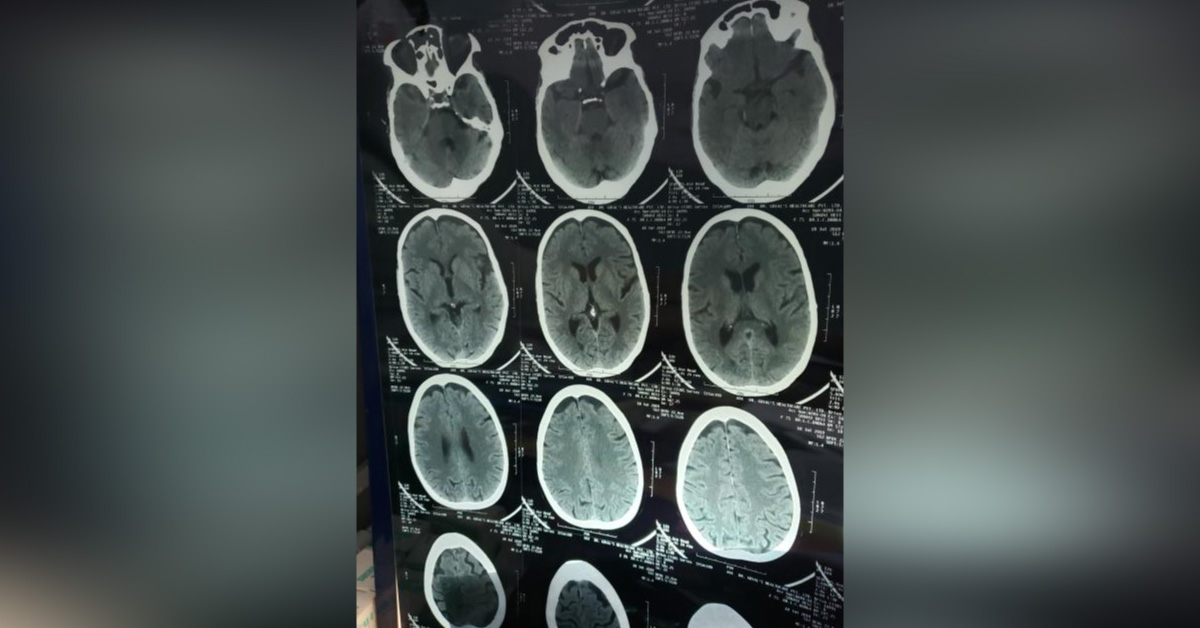 What Happened To This Patient C/o Sudden Headache ?