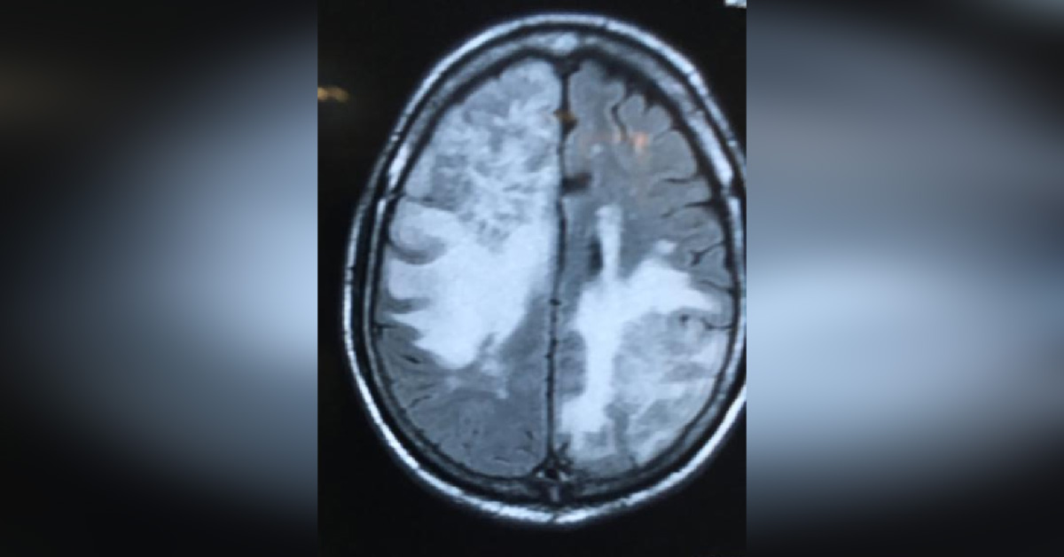 Above Forty Years Psychiatric Symptoms Need More Screening