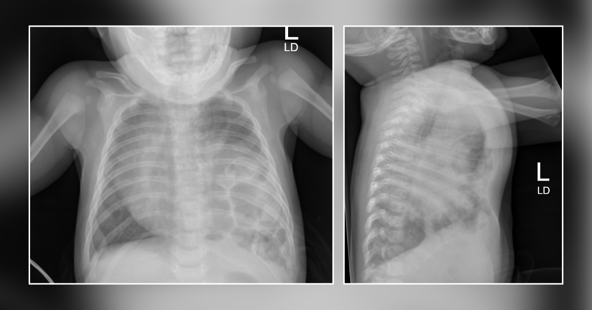 Case of an Infant with Pectus Excavatum