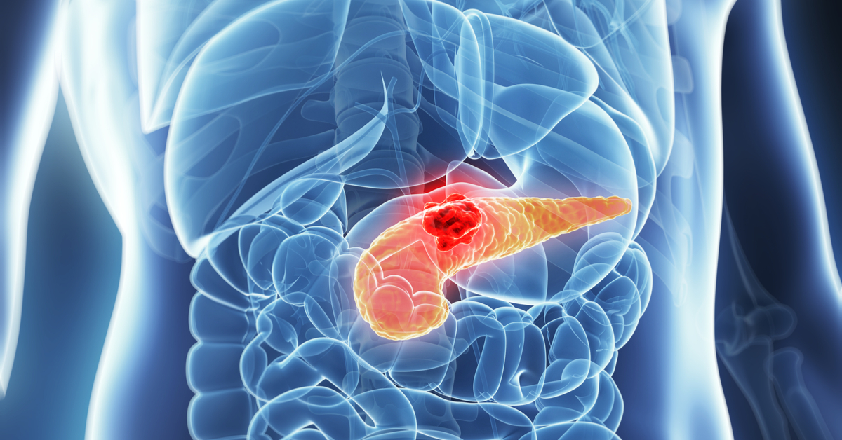 High Blood Sugar May Elevate Risk Of Pancreatic Cancer