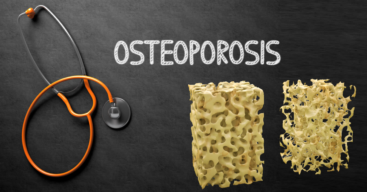 Osteoporosis — The Silent Disease
