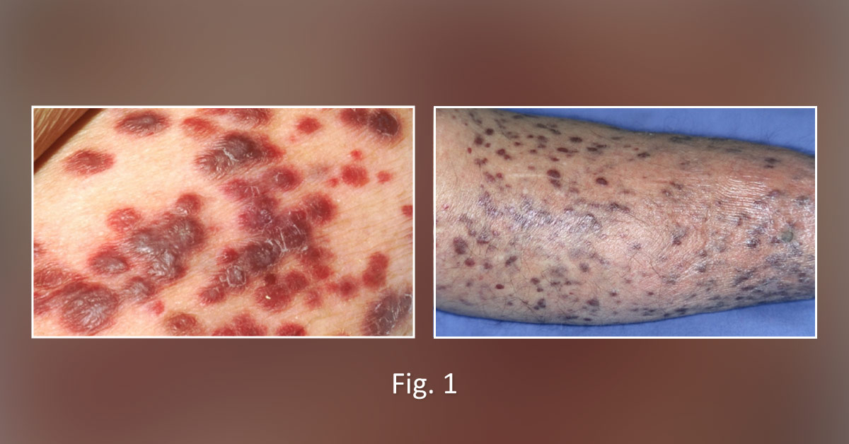 A Patient with an Unusual Skin Rash