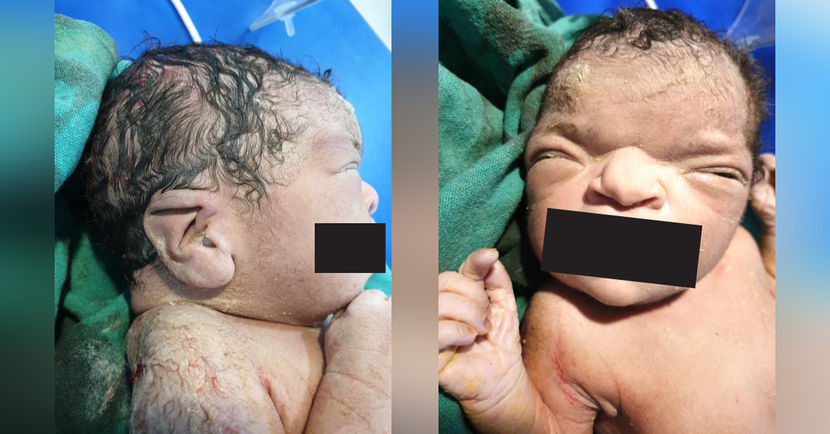 Facial Dysmorphism
