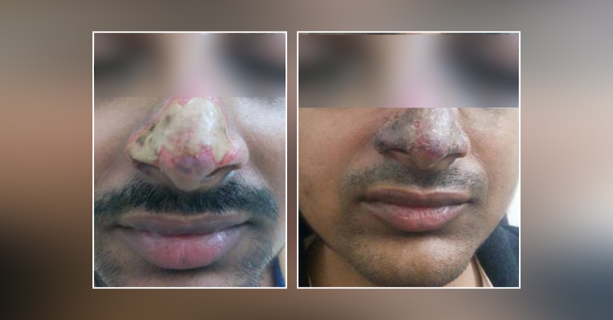 Side Effects Of Dermal Fillers!