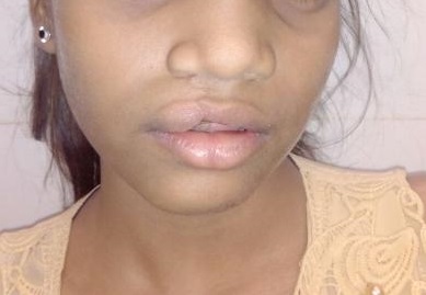 Lip Rejuvenation With Whistle Deformity