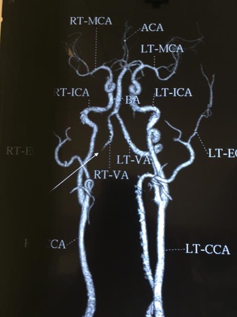 Stroke And Imaging Workup