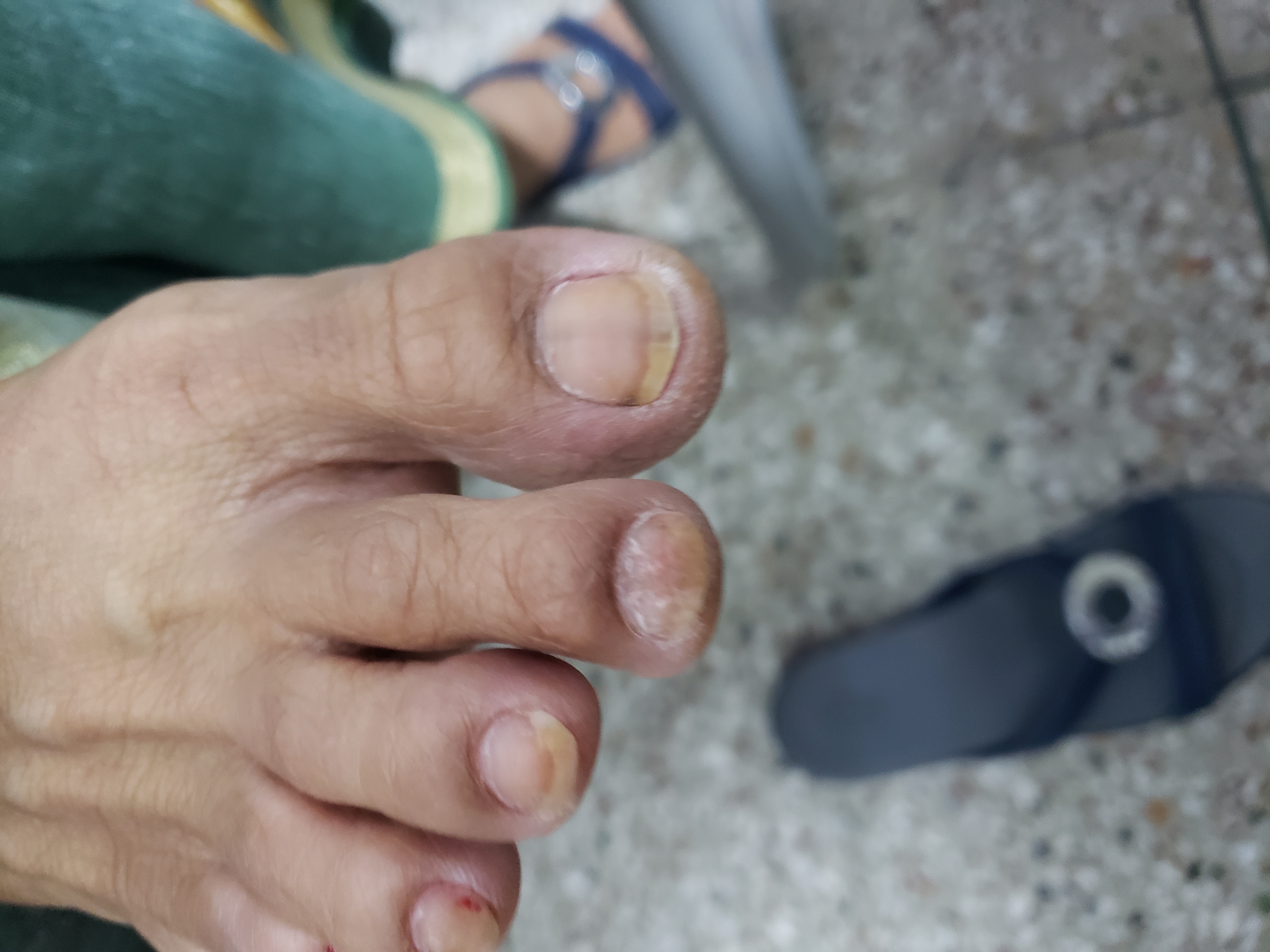 Explain Significance Of Black Line On Big Toe Nail