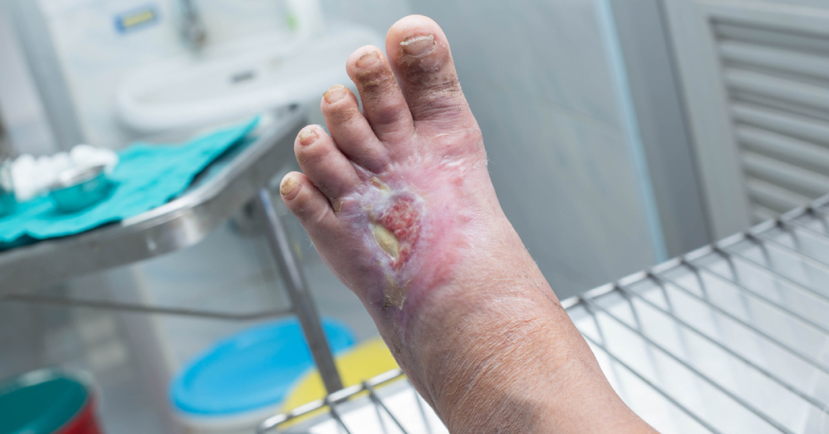 Diabetic Foot- Need For Prevention