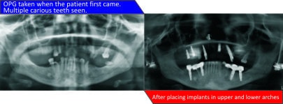 Implant Based Overdenture…